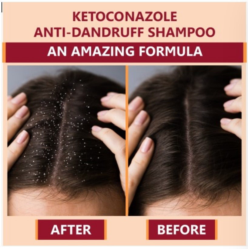 New Ketokem - Bottle of 110ml Anti-Dandruff Shampoo Pack of - 1